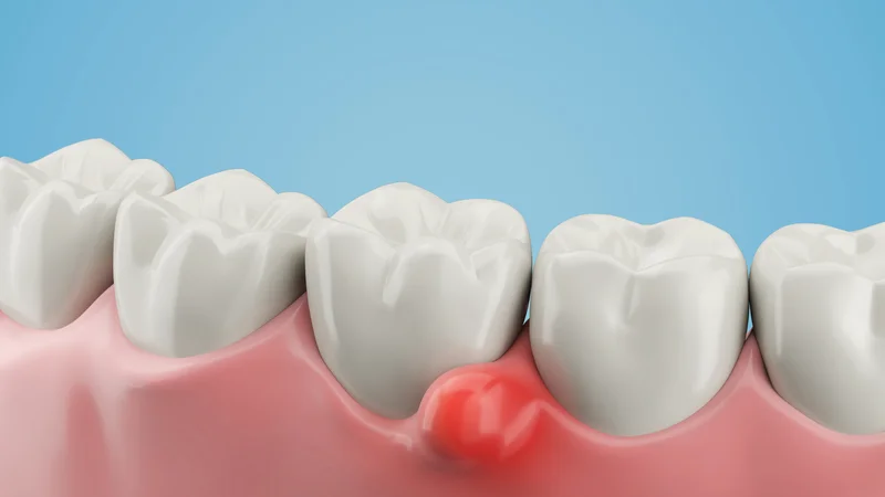 Šta je dentalna cista i kako se leči?