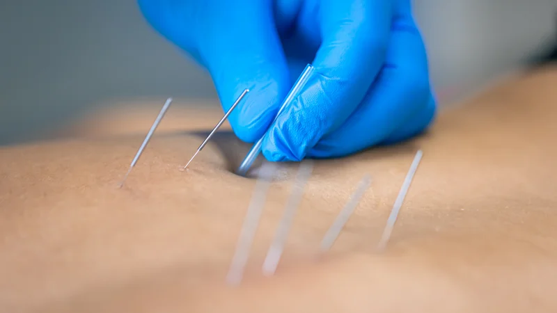 Šta je dry needling i za koje bolove se koristi?