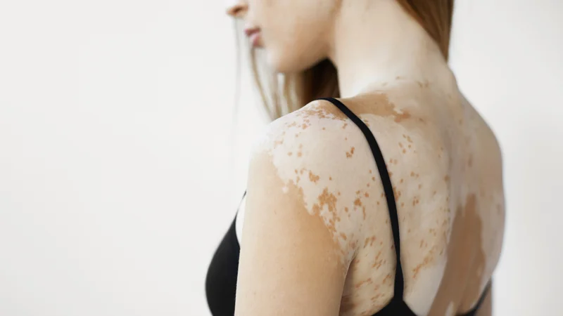 Šta je melanin i zbog čega može biti smanjen?